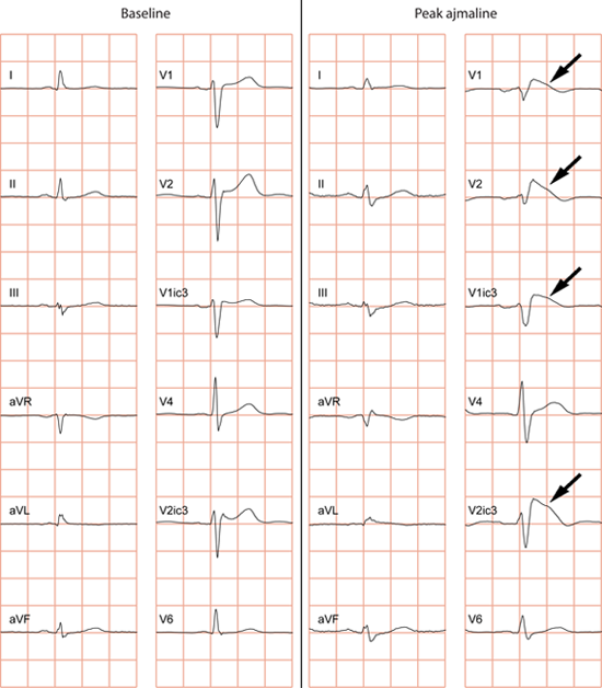 Diagnostic drugs for Brugada syndrome | BrugadaDrugs.org